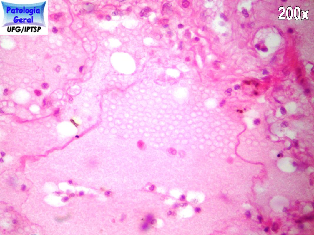 Edema Iptsp Patologia